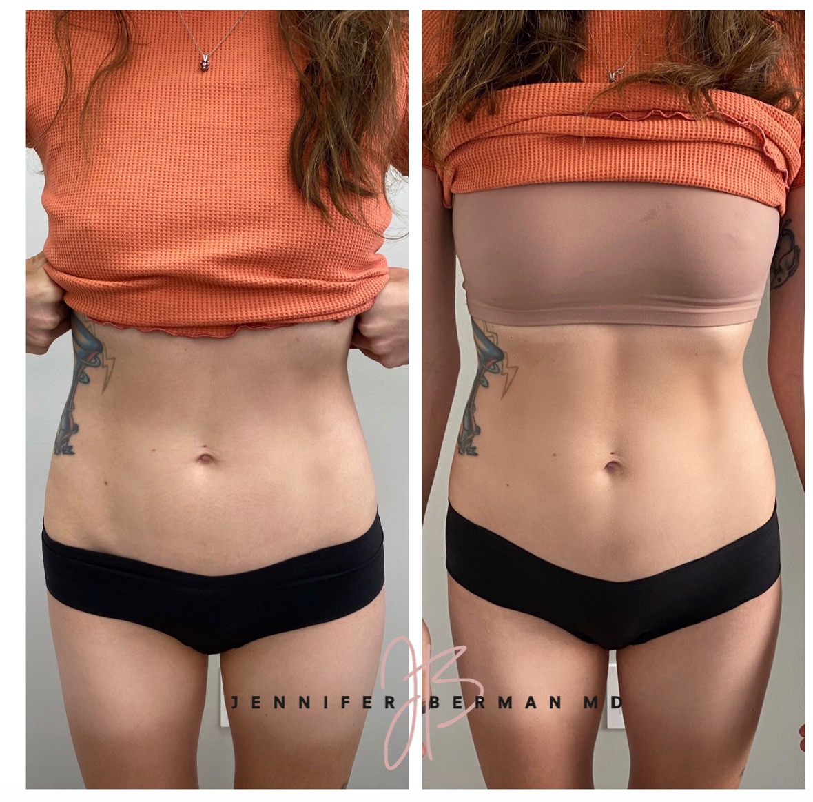 Before and after comparison showing abdominal toning results, highlighting changes during menopause.