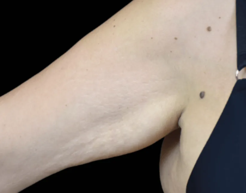 A close-up of a human arm showing the elbow with a couple of moles/freckles on the skin, reviewed by a Sexual Health Expert in Los Angeles.