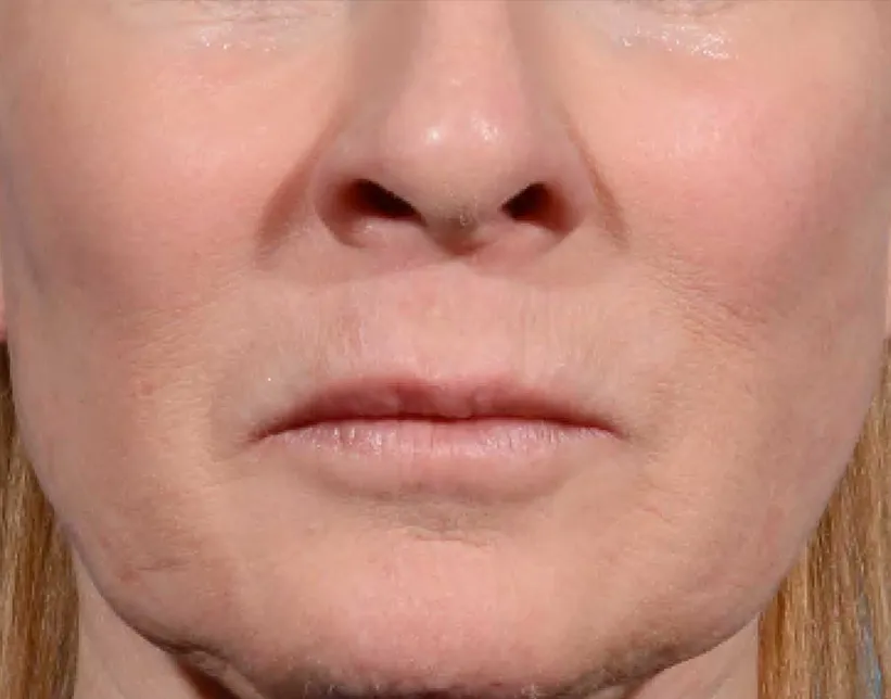 Close-up of a Sexual Health Expert's lower face showing the nose, mouth, and chin area in Los Angeles, with a neutral expression.