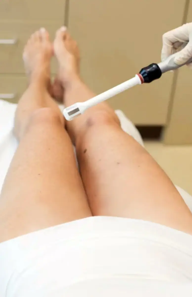 A patient lying down with their legs extended while a Sexual Health Expert in Los Angeles uses a dermatological tool for a skin treatment or examination on the leg.