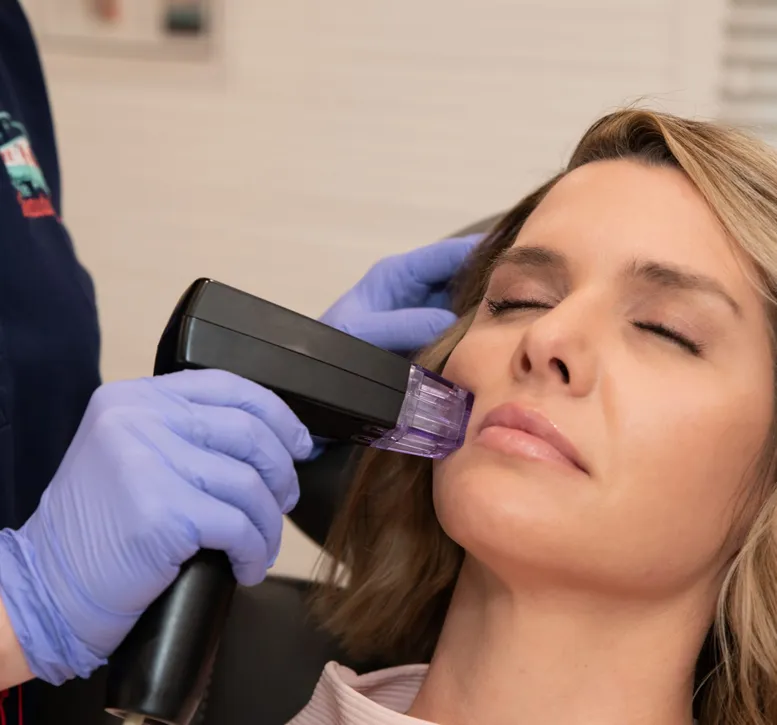 A person receiving a microneedling treatment from a Sexual Health Expert in Los Angeles with a dermaroller device.