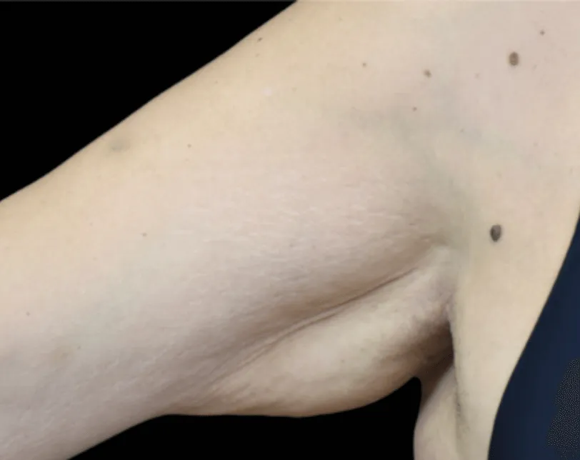 A close-up view of a human elbow with relaxed skin and a few moles visible on the forearm, reviewed by a Sexual Health Expert in Los Angeles.
