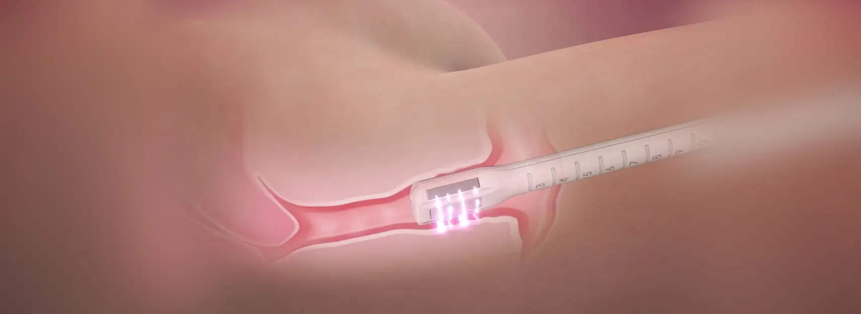 An illustration of a stent being placed in a blood vessel by a sexual health expert in Los Angeles to improve blood flow.