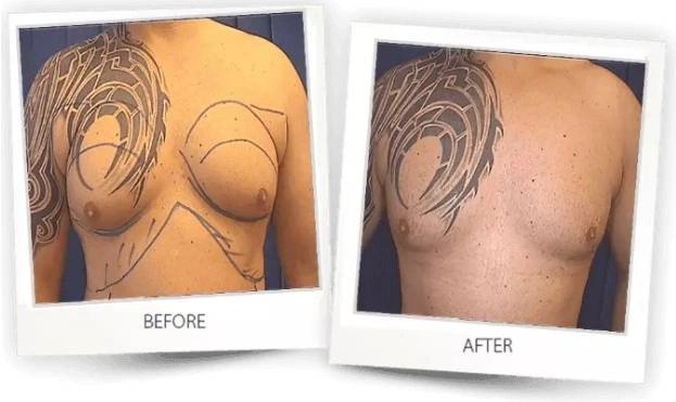 Before and after images showcasing the results of a tattoo removal procedure on a person's back, overseen by a Sexual Health Expert in Los Angeles.